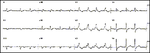 Resultado EKG