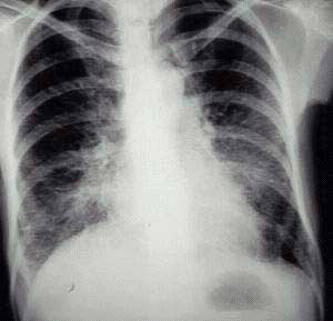 Patrón metastásico alveolar
