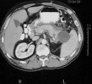 TAC abdominal