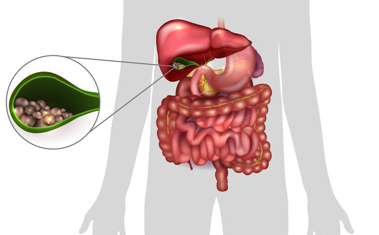 Alteración genómica de la colelitiasis