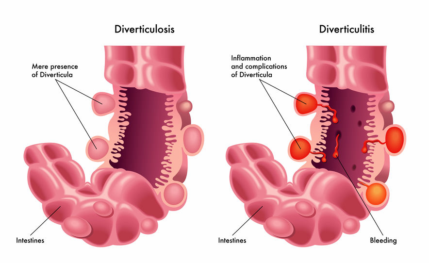 Diverticulitis Causas S ntomas Diagn stico Y Tratamiento TUXQR