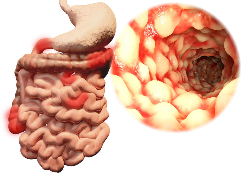 Enfermedad De Crohn