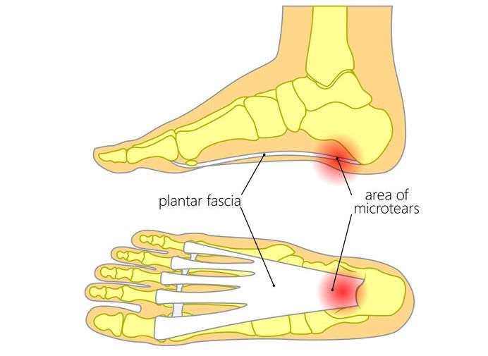 Cómo se trata la fascitis plantar?