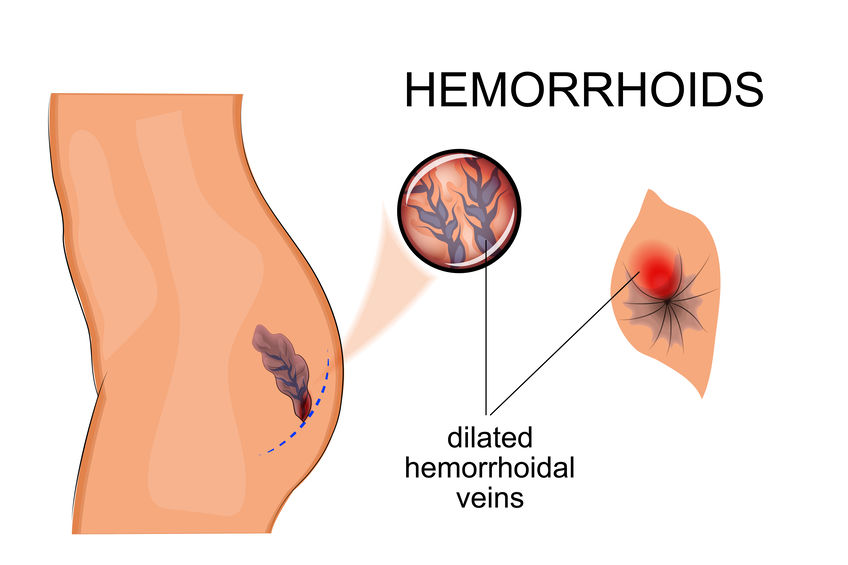 Hemorroides en el embarazo: ¿Por qué aparecen?