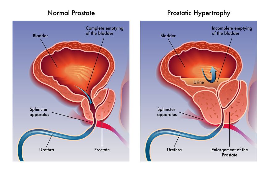 hipertrofia benigna de prostata que es