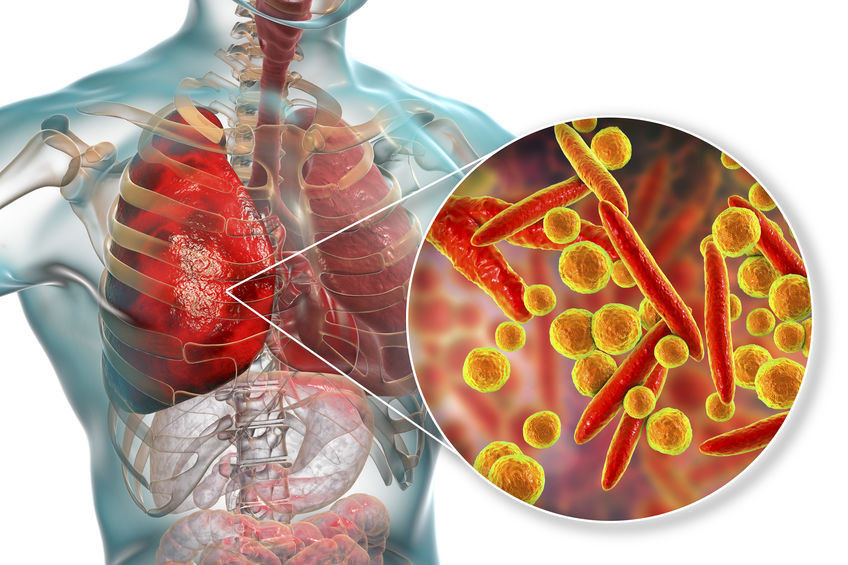 Mycoplasma Pneumoniae bacteria que ataca los Pulmones.