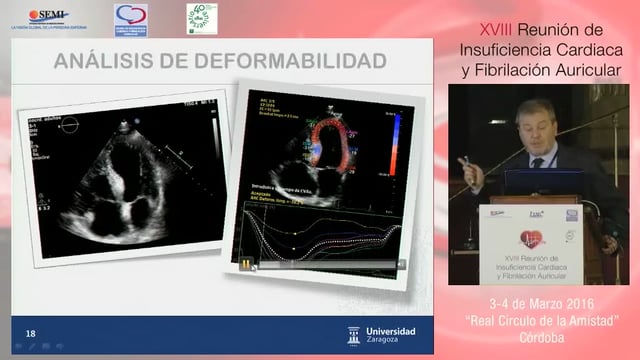 IC con FEVI preservada: nuevos aspectos fisiopatológicos