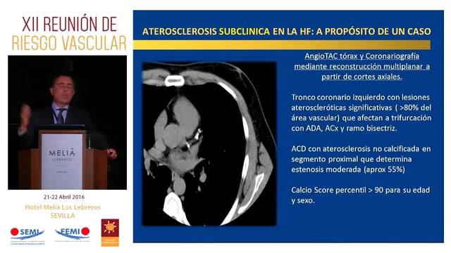 La hipercolesterolemia familiar heterocigótica unida a otros factores de riesgo. ¿Cómo podemos actuar?