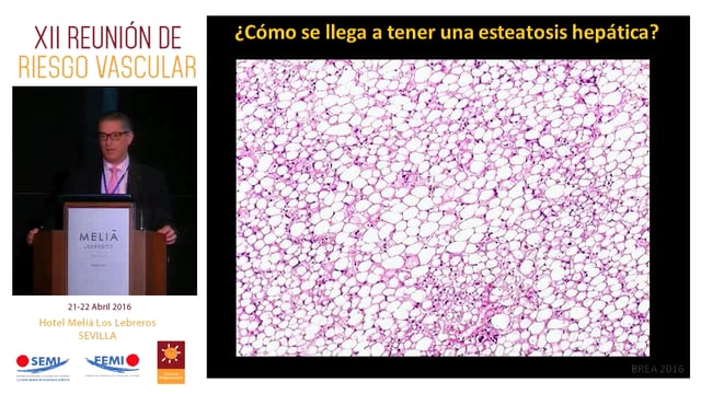 ¿Cómo se llega a tener una esteatosis hepática?